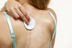 Health,Problem,,Skin,Diseases.,Young,Woman,With,Acne,,Red,Spots