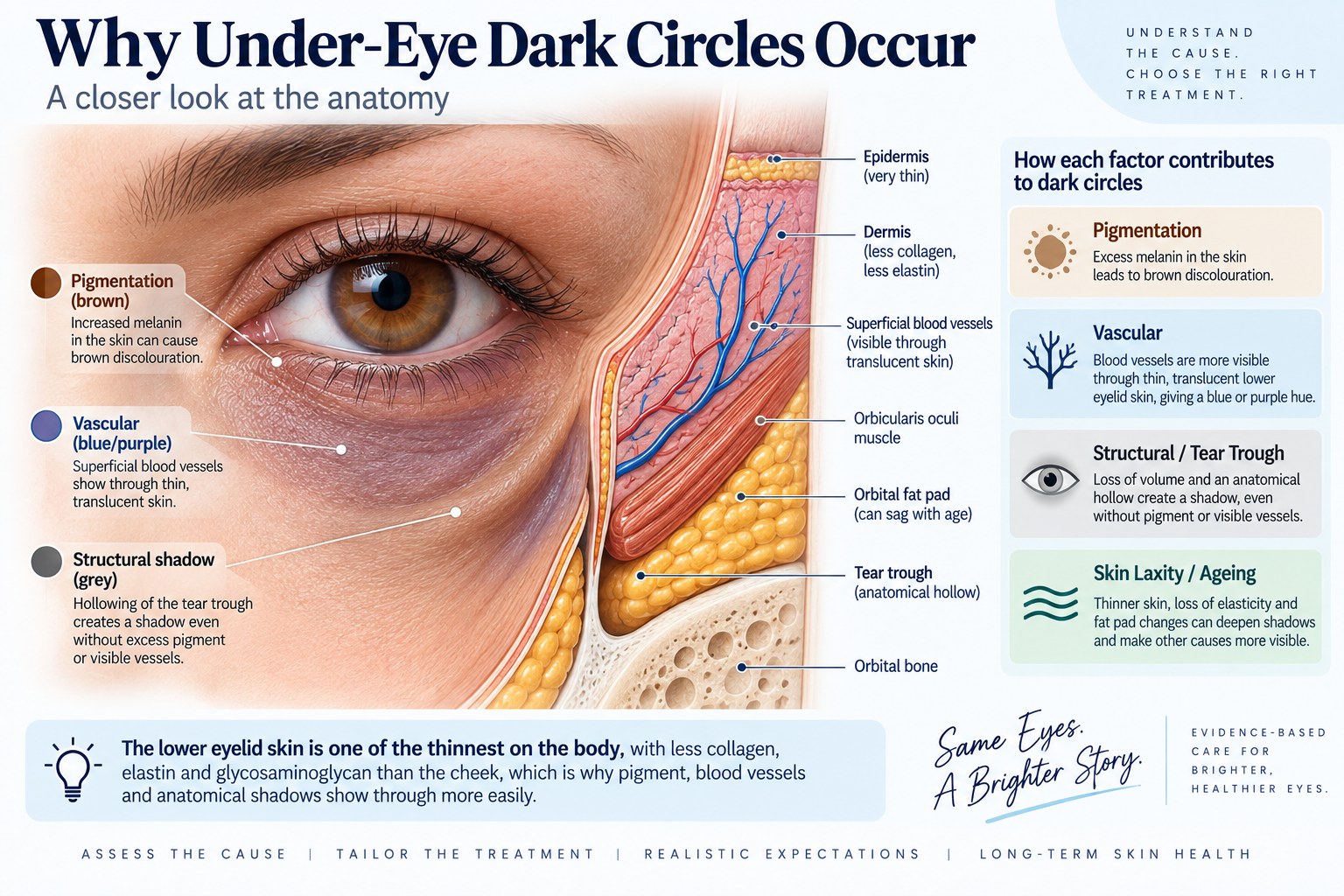 Anatomy of the under-eye area showing the tear trough, skin and vessels